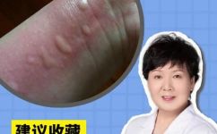吃了发物怎么办补救(急救吃了发物后，这些方法可以帮你减少伤害)