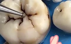 补牙步骤流程(补牙须知：完整步骤及流程解析)