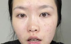 使用水杨酸的反应(水杨酸反应的用途方法及注意事项)